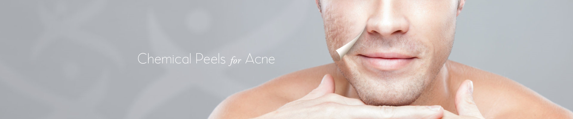 Hanna hunter anal Facial peels for acne
