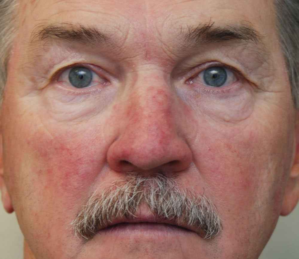Picture of Rosacea - WebMD