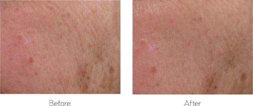 Biocream before after