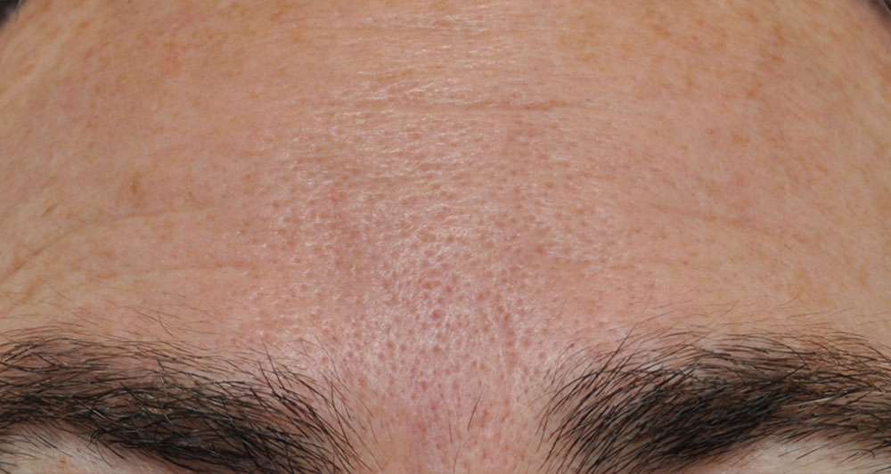 Forehead Lines after
