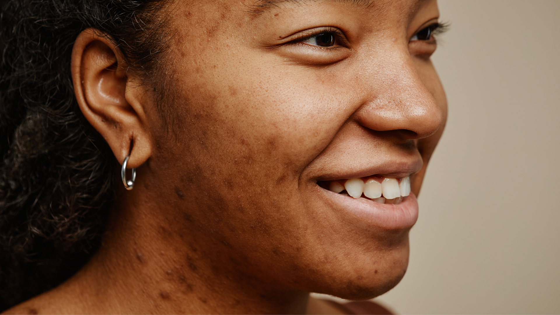 Target Areas (Key Benefits)_Acne
