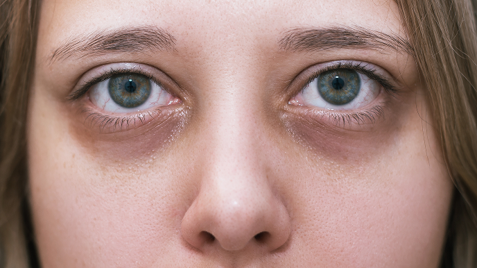 DARK CIRCLES_UNDER EYE