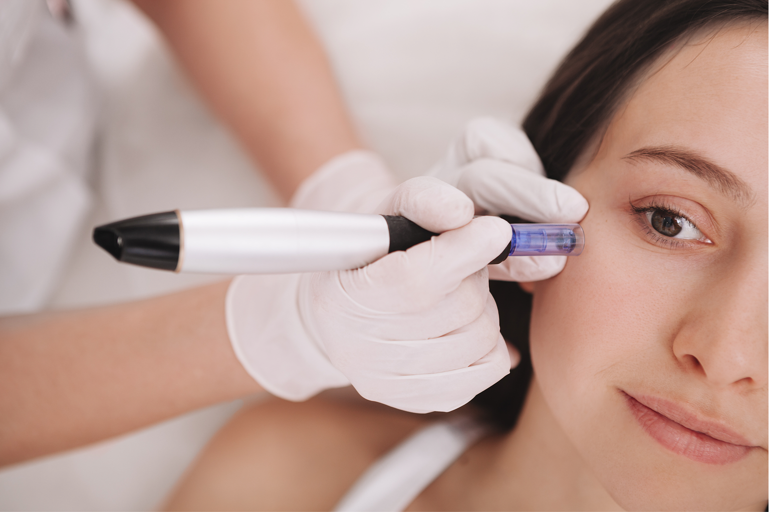 MICRONEEDLING UNDER EYE