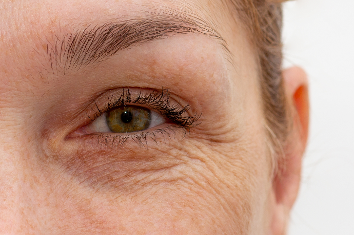 TEAR TROUGHS_UNDER EYE
