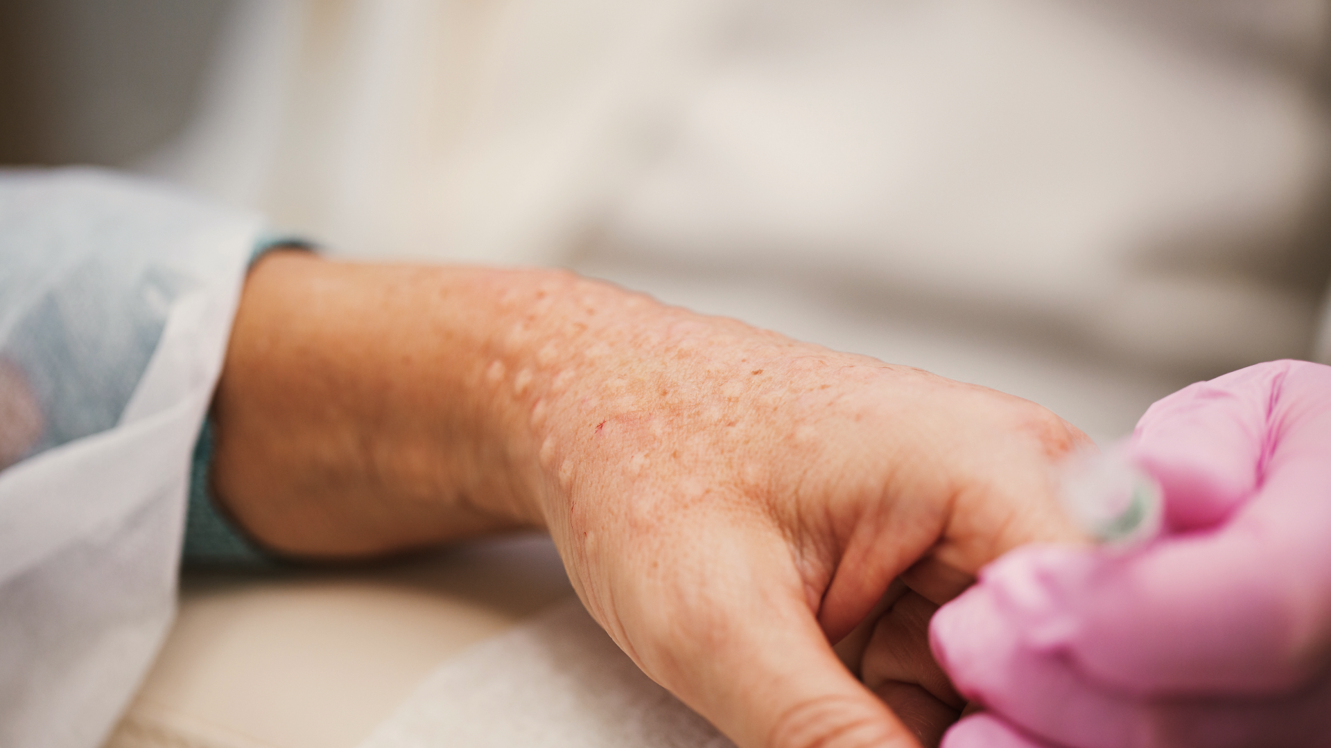 Treatment in Action_Hand Rejuvenation